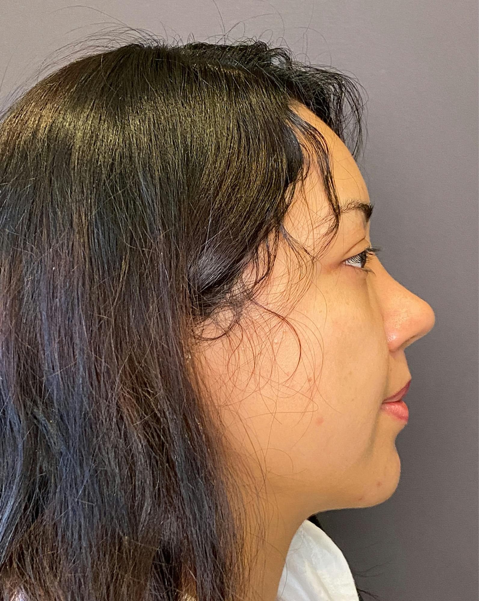 Rhinoplasty Before & After Gallery - Patient 151510782 - Image 2