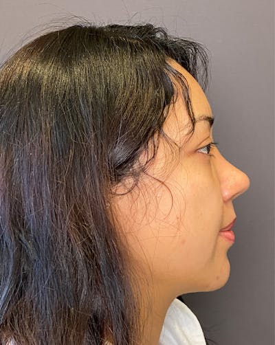 Rhinoplasty Before & After Gallery - Patient 151510782 - Image 2