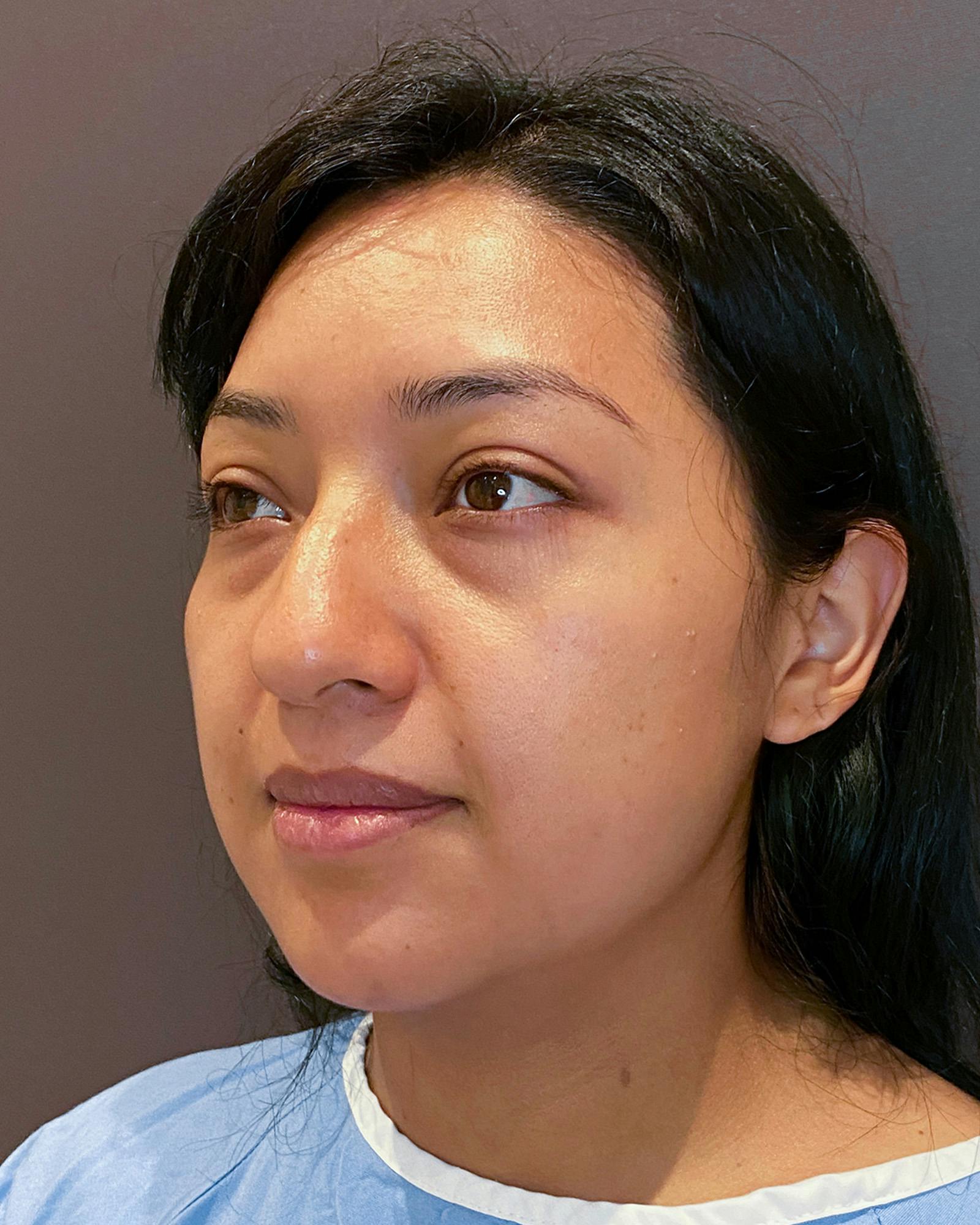Rhinoplasty Before & After Gallery - Patient 151510782 - Image 5