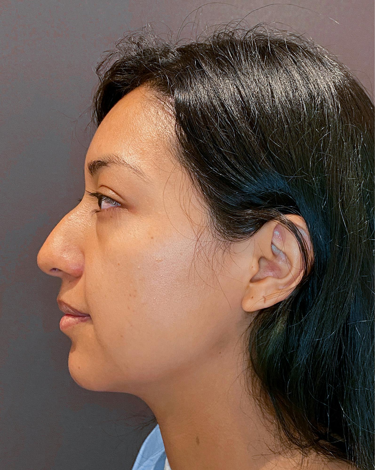 Rhinoplasty Before & After Gallery - Patient 151510782 - Image 7