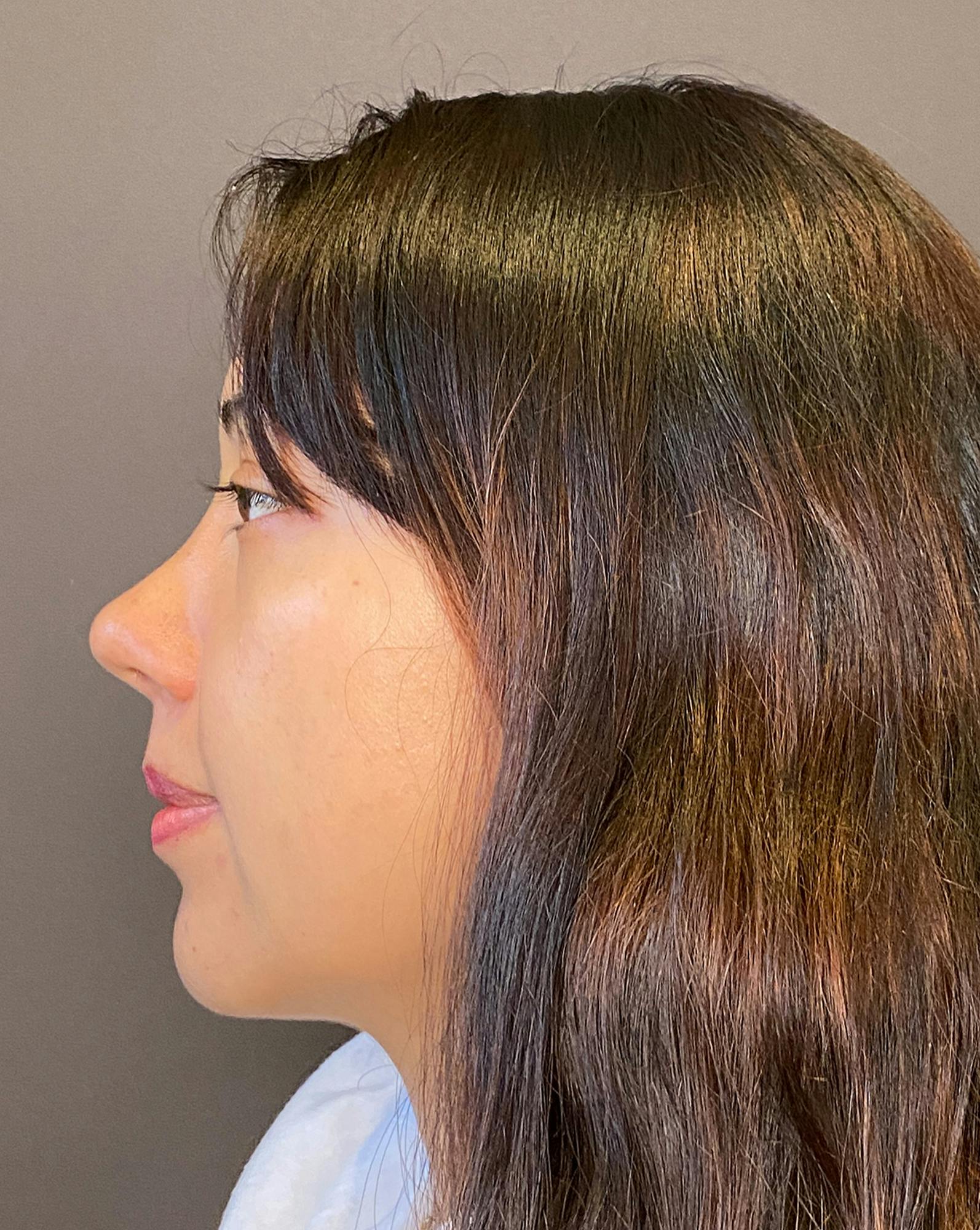 Rhinoplasty Before & After Gallery - Patient 151510782 - Image 8