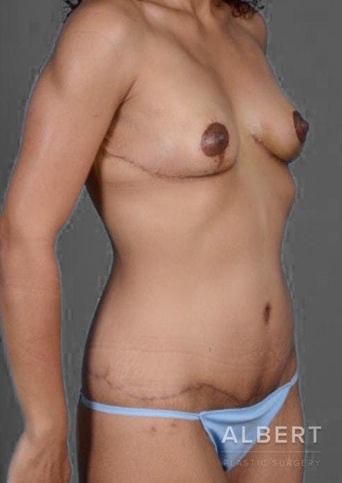 Body Lift Before & After Gallery - Patient 151351680 - Image 2