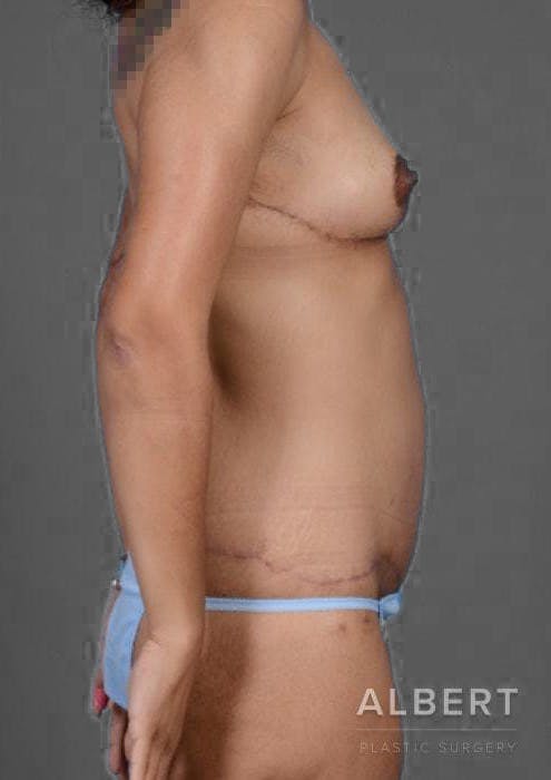 Body Lift Before & After Gallery - Patient 151351680 - Image 4