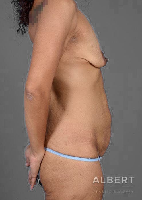 Body Lift Before & After Gallery - Patient 151351680 - Image 3