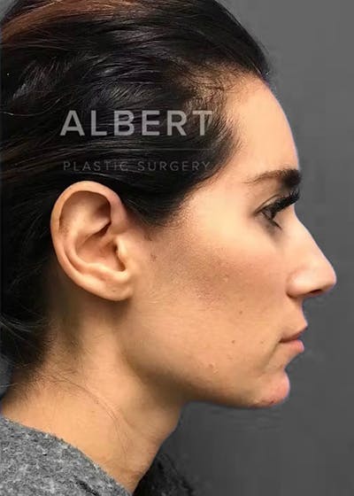 Chin Augmentation Before & After Gallery - Patient 151362561 - Image 1