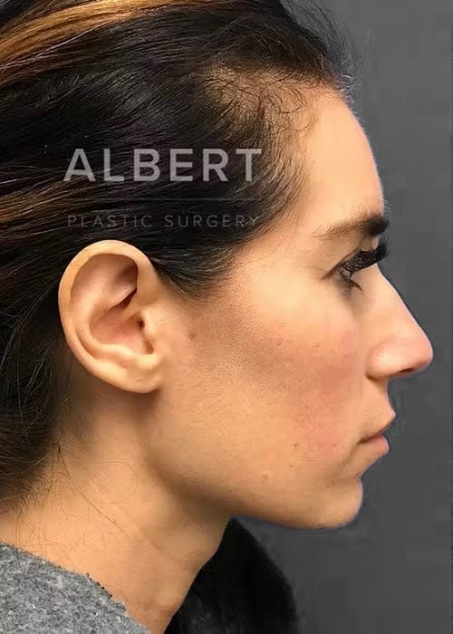 Chin Augmentation Before & After Gallery - Patient 151362561 - Image 2