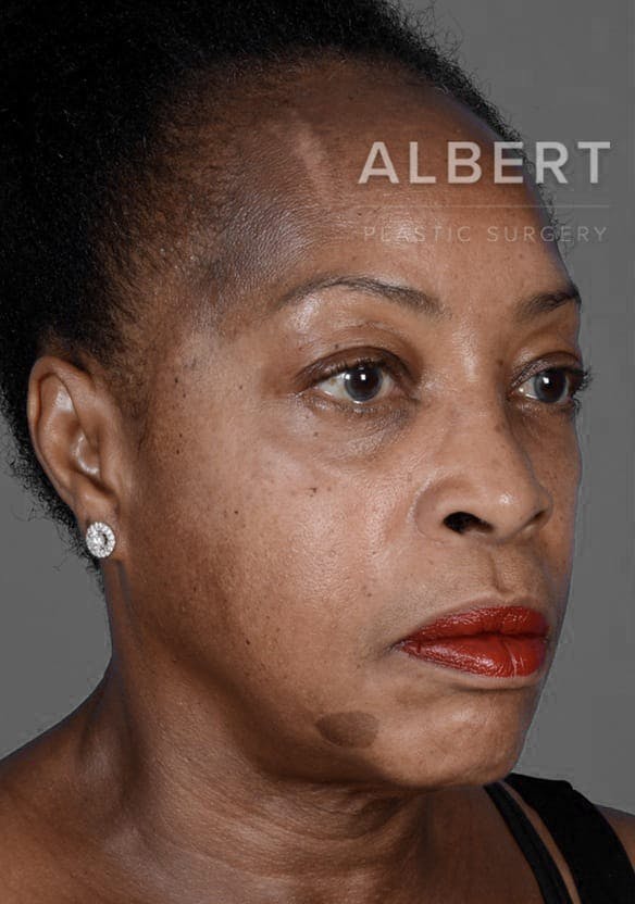 Chin Augmentation Before & After Gallery - Patient 151362562 - Image 3