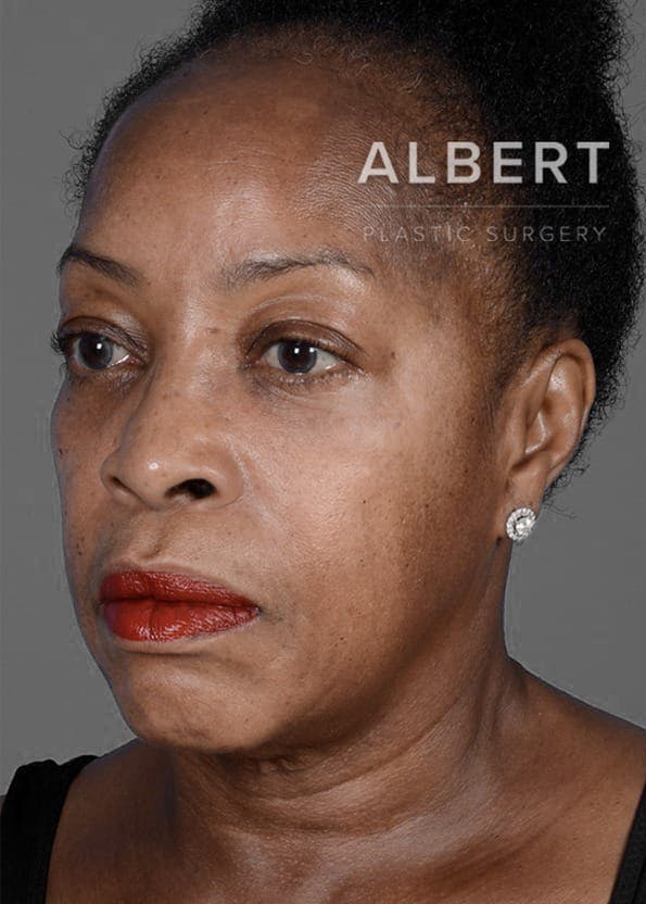 Chin Augmentation Before & After Gallery - Patient 151362562 - Image 5