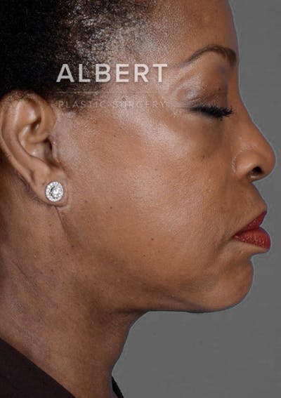 Chin Augmentation Before & After Gallery - Patient 151362562 - Image 2