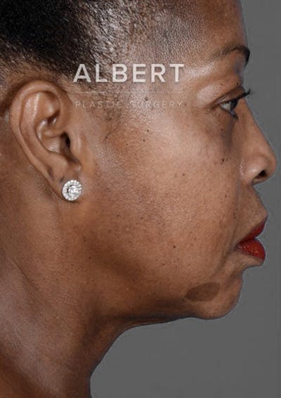 Chin Augmentation Before & After Gallery - Patient 151362562 - Image 1