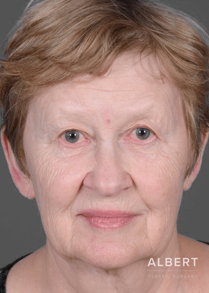 Eyelid Surgery Before & After Gallery - Patient 151362566 - Image 1