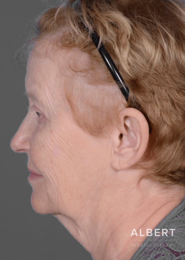 Eyelid Surgery Before & After Gallery - Patient 151362566 - Image 10