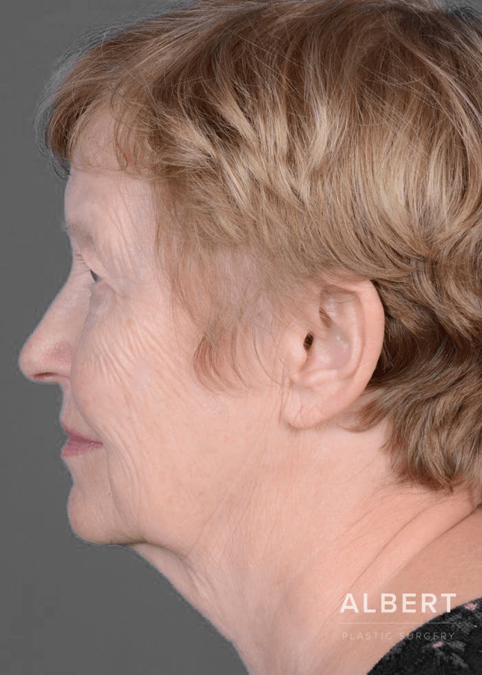 Eyelid Surgery Before & After Gallery - Patient 151362566 - Image 9