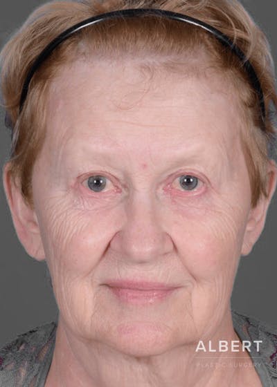 Eyelid Surgery Before & After Gallery - Patient 151362566 - Image 2