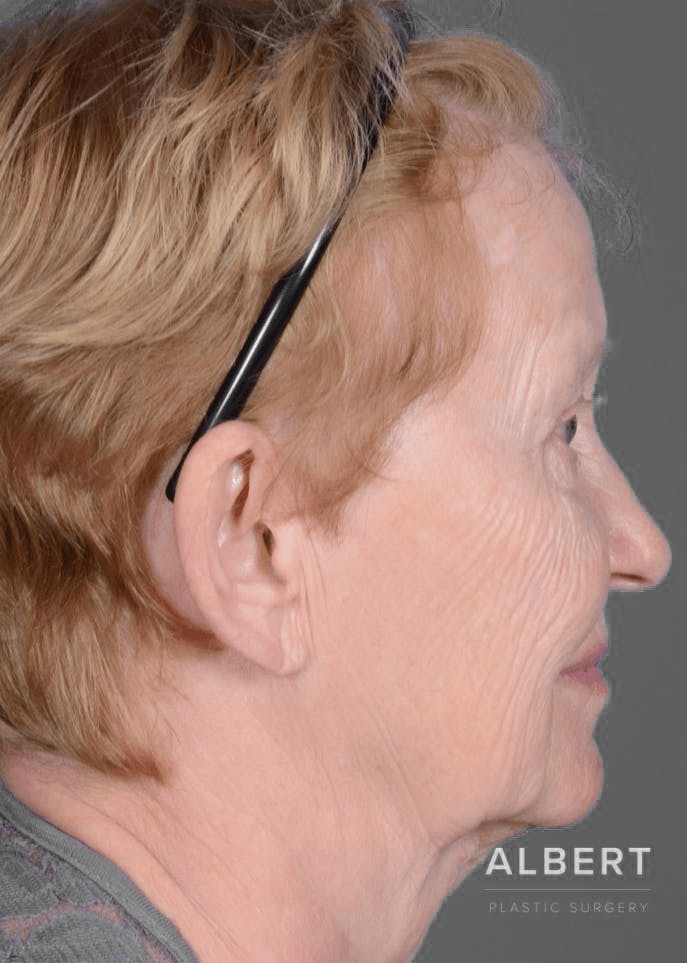 Eyelid Surgery Before & After Gallery - Patient 151362566 - Image 6