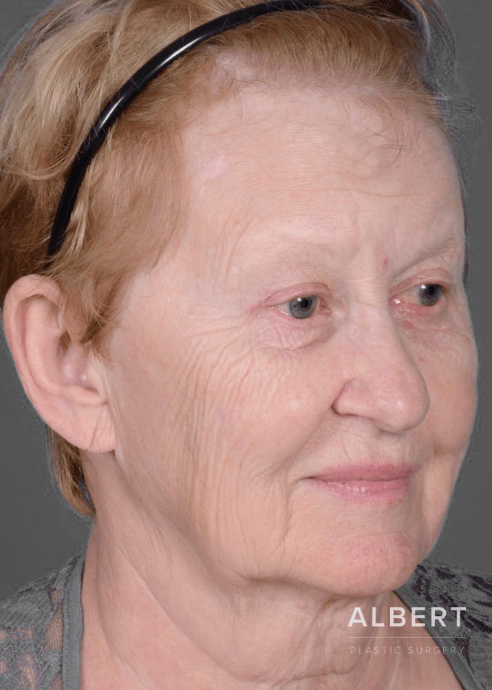 Eyelid Surgery Before & After Gallery - Patient 151362566 - Image 4