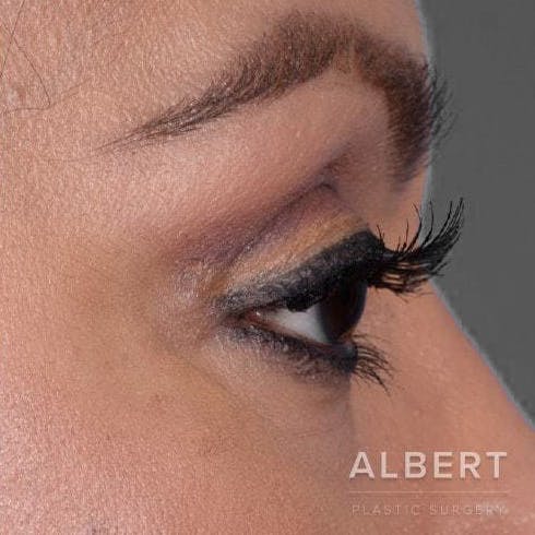 Eyelid Surgery Before & After Gallery - Patient 151362568 - Image 4