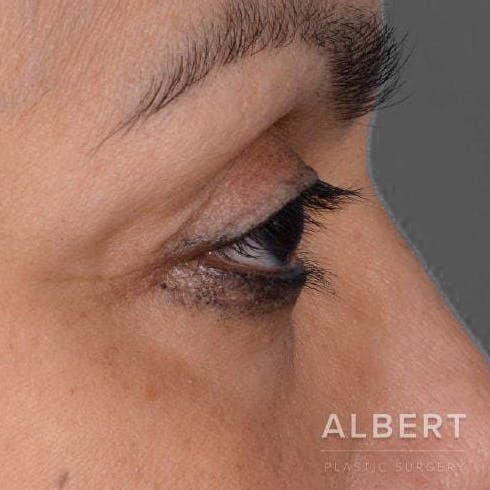 Eyelid Surgery Before & After Gallery - Patient 151362568 - Image 3