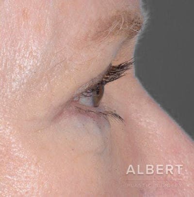 Eyelid Surgery Before & After Gallery - Patient 151398570 - Image 2