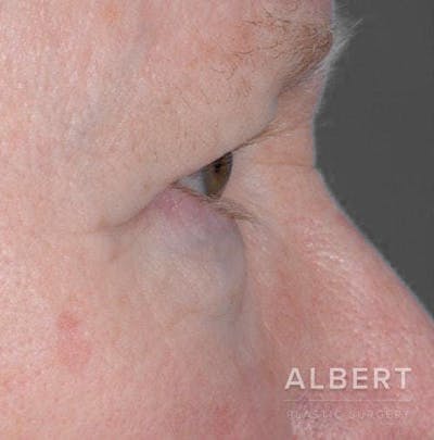 Eyelid Surgery Before & After Gallery - Patient 151398570 - Image 1