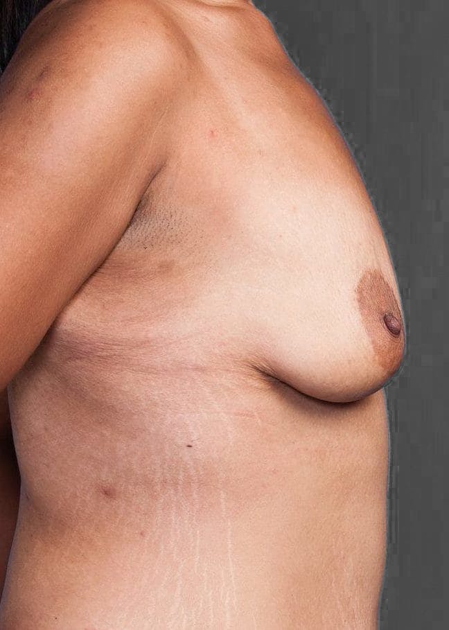 Breast Reduction Before & After Gallery - Patient 173904783 - Image 5