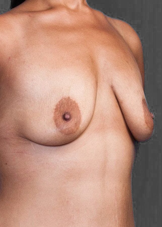 Breast Lift / Reduction Before & After Gallery - Patient 151362537 - Image 3