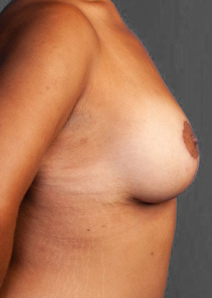 Breast Lift / Reduction Before & After Gallery - Patient 151362537 - Image 6
