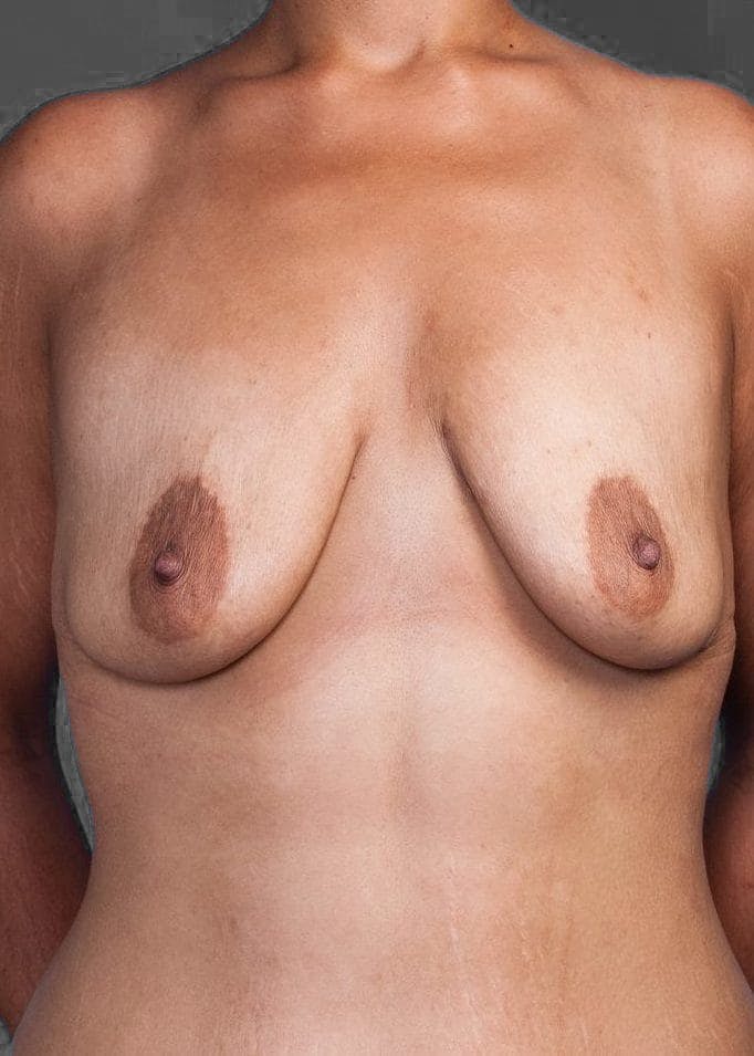 Breast Lift / Reduction Before & After Gallery - Patient 151362537 - Image 1