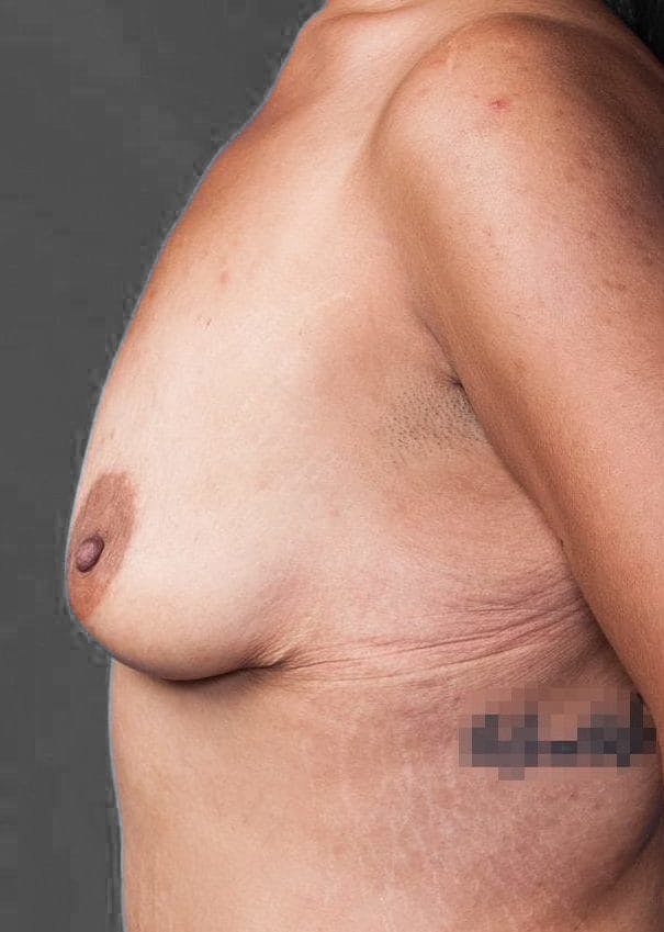 Breast Reduction Before & After Gallery - Patient 173904783 - Image 9
