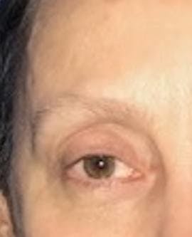 Eyelid Surgery Before & After Gallery - Patient 151362567 - Image 2