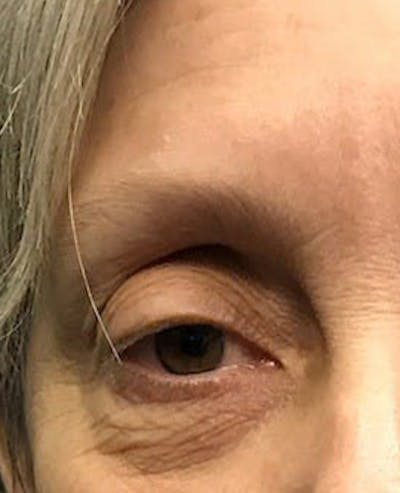 Eyelid Surgery Before & After Gallery - Patient 151362567 - Image 1