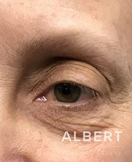 Eyelid Surgery Before & After Gallery - Patient 151362567 - Image 5