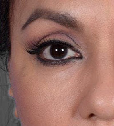 Eyelid Surgery Before & After Gallery - Patient 151362568 - Image 2
