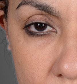 Eyelid Surgery Before & After Gallery - Patient 151362568 - Image 1