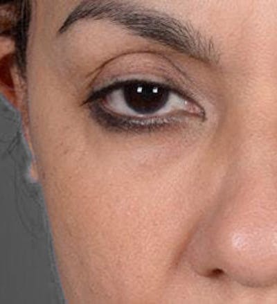 Eyelid Surgery Before & After Gallery - Patient 151362568 - Image 1