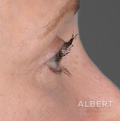 Eyelid Surgery Before & After Gallery - Patient 151398571 - Image 2