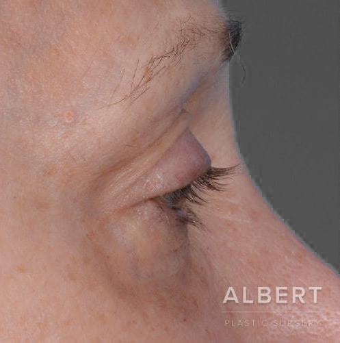Eyelid Surgery Before & After Gallery - Patient 151398571 - Image 1