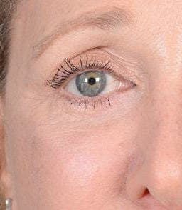 Eyelid Surgery Before & After Gallery - Patient 151398571 - Image 4