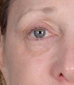 Eyelid Surgery Before & After Gallery - Patient 151398571 - Image 1