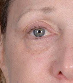 Eyelid Surgery Before & After Gallery - Patient 151398571 - Image 3
