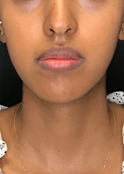 Lip Lift / Lip Reduction Before & After Gallery - Patient 151452137 - Image 1