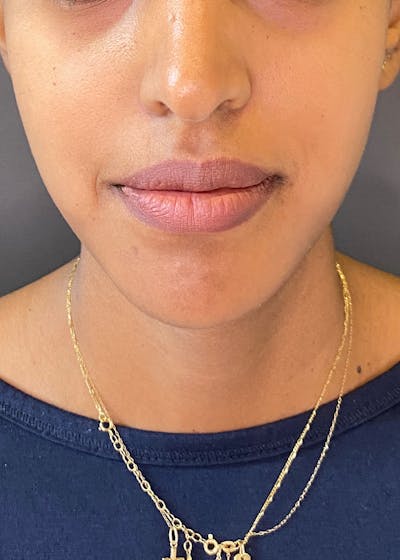 Lip Lift / Lip Reduction Before & After Gallery - Patient 151452137 - Image 2