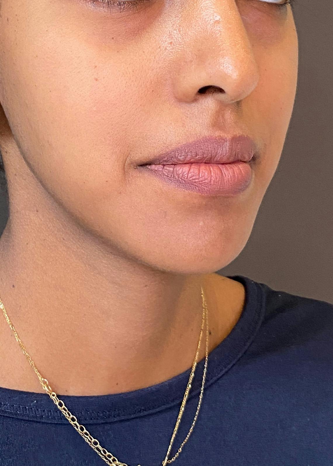 Lip Lift / Lip Reduction Before & After Gallery - Patient 151452137 - Image 4