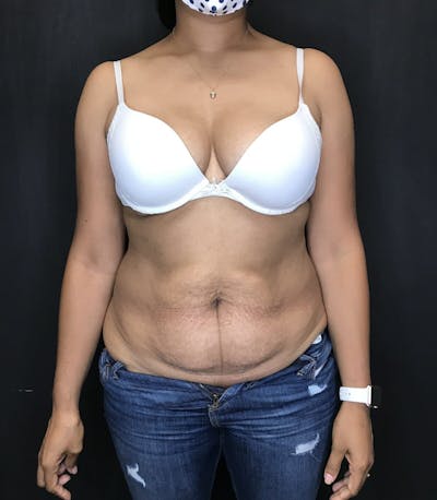 Tummy Tuck Before & After Gallery - Patient 151521127 - Image 1
