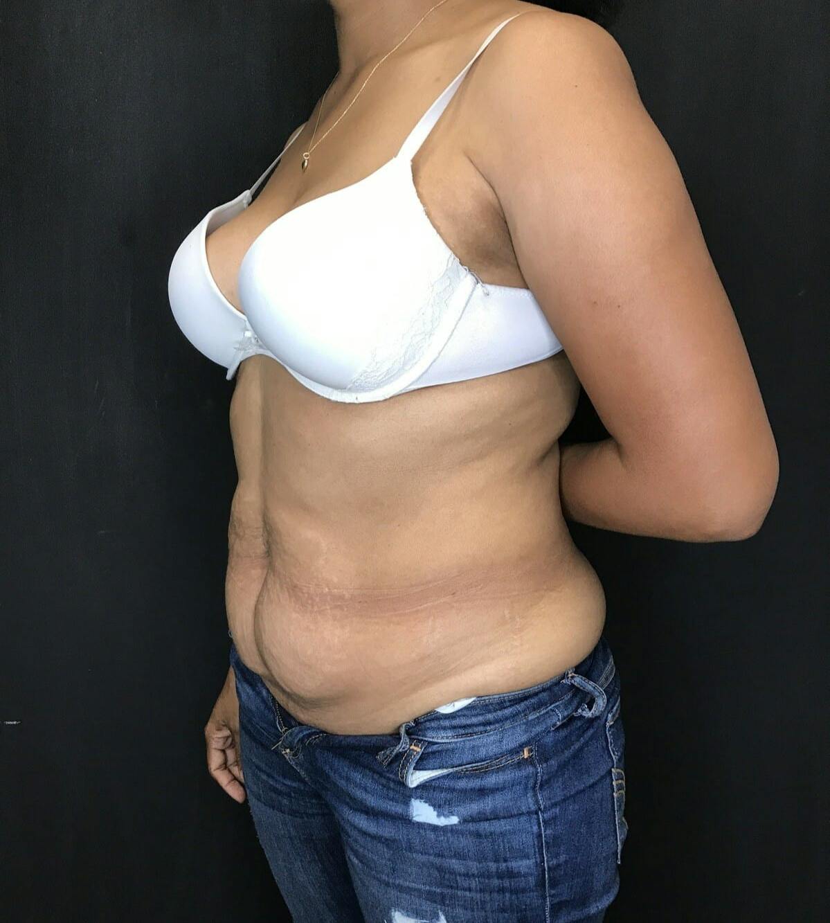 Tummy Tuck Before & After Gallery - Patient 151521127 - Image 3