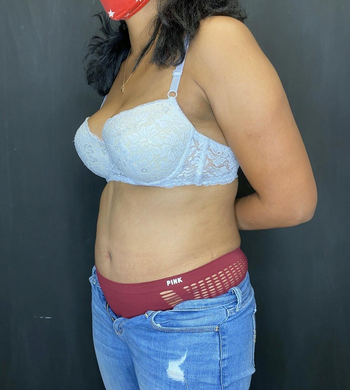 Tummy Tuck Before & After Gallery - Patient 151521127 - Image 4