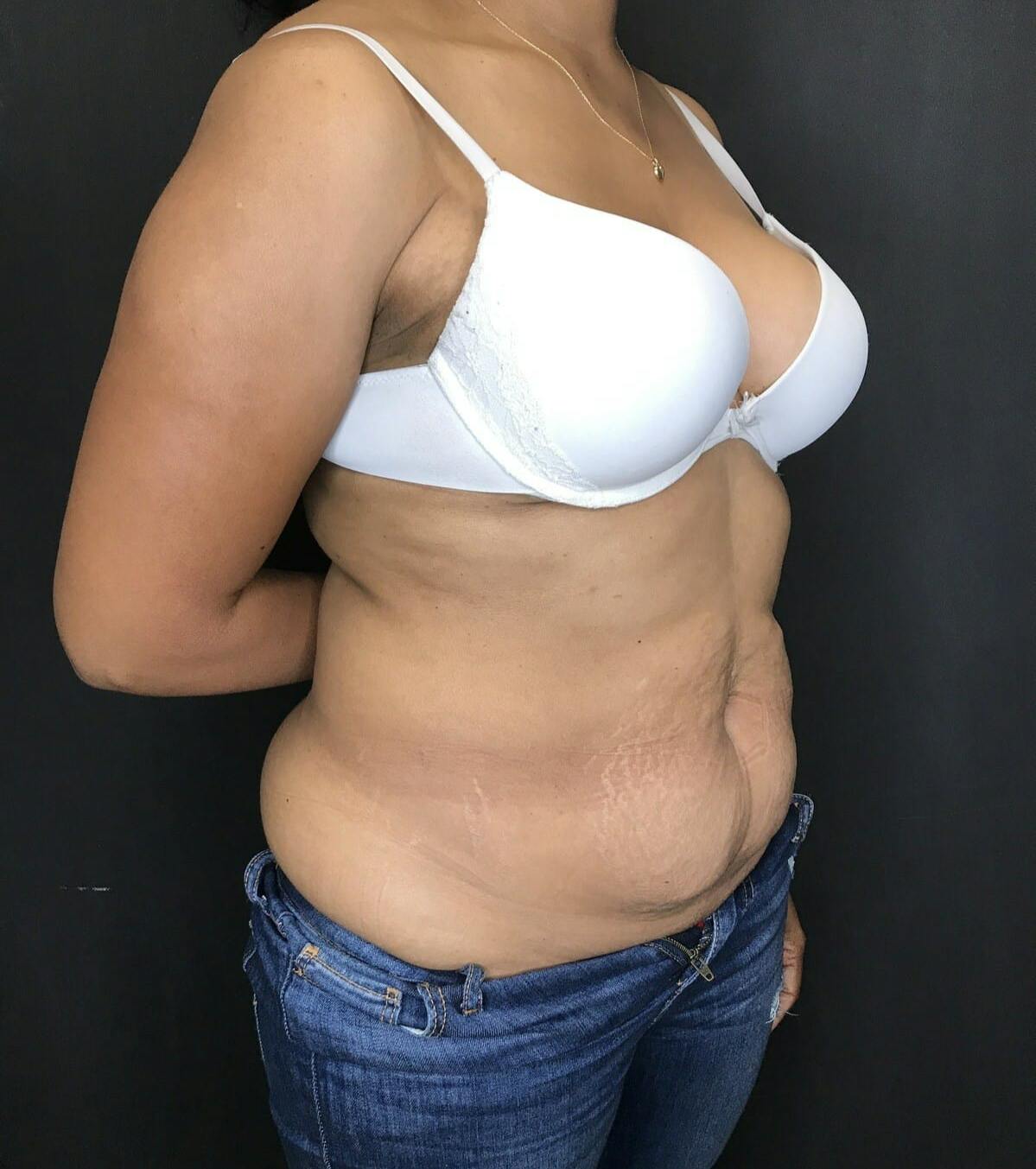 Tummy Tuck Before & After Gallery - Patient 151521127 - Image 5