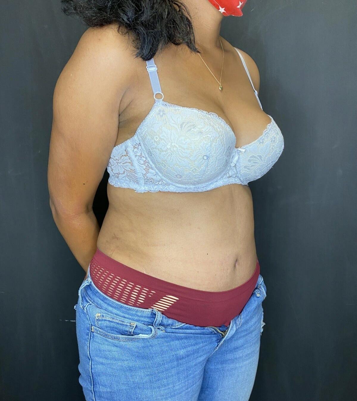 Tummy Tuck Before & After Gallery - Patient 151521127 - Image 6