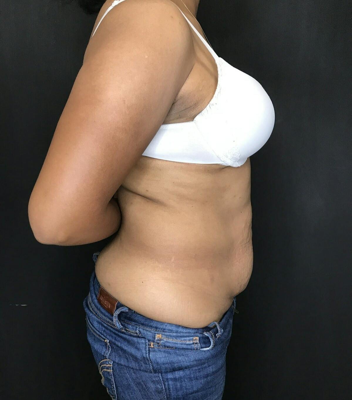 Tummy Tuck Before & After Gallery - Patient 151521127 - Image 7