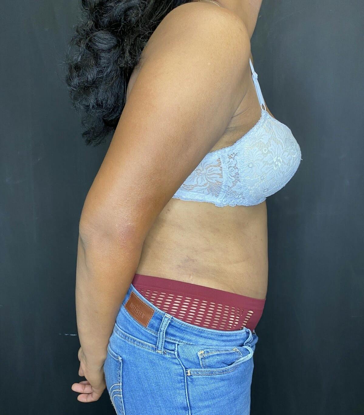 Tummy Tuck Before & After Gallery - Patient 151521127 - Image 8